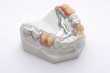 Modellguss-Prothese mit Klammern Modellguss-Prothese mit Klammern