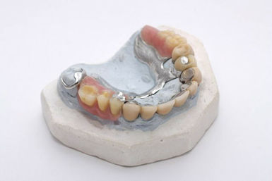 Eingegliederte Modellguss-Prothese Eingegliederte Modellguss-Prothese