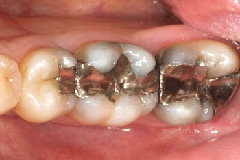 Defekte Amalgamfüllungen