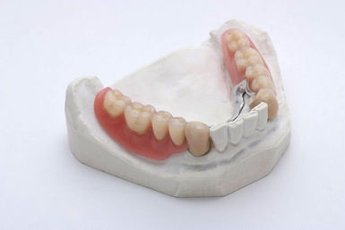 Eingegliederte Teleskop-Prothese Eingegliederte Teleskop-Prothese