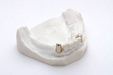 Gold-Teleskope im Unterkiefer Gold-Teleskope im Unterkiefer