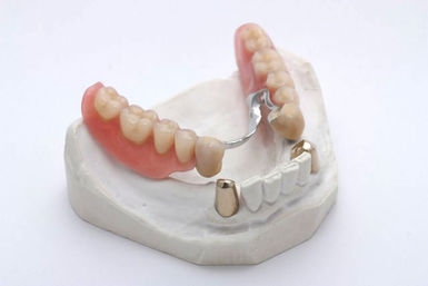 Eingliederung einer Teleskop-Prothese Eingliederung einer Teleskop-Prothese