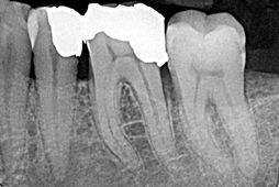 2. Großflächige Amalgamfüllungen 2. Großflächige Amalgamfüllungen