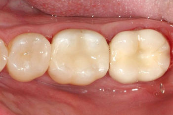 Füllung, Cerec (Keramik-Inlay), Krone (von li. nach re.)