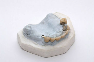 Kronen im Oberkiefer mit Befestigungs-elementen für eine Prothese Kronen im Oberkiefer mit Befestigungs-elementen für eine Prothese