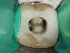 1. Eingänge der Wurzelkanäle 1. Eingänge der Wurzelkanäle